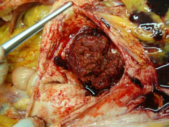 aortic aneurysm with thrombus